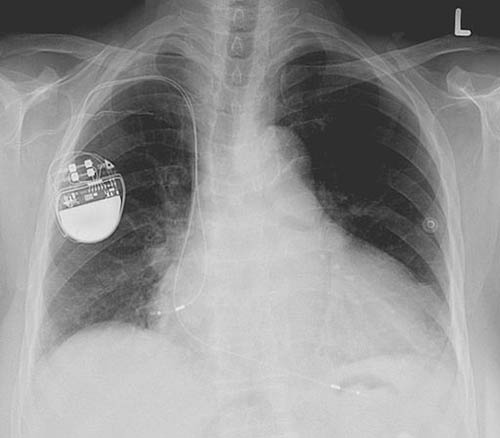 Black and white x-ray image of a human chest (lungs, ribcage, spine, collarbone) with a pacemaker embedded on the left, a circular shape, solid white on the bottom, with wires and other electrical components on top.