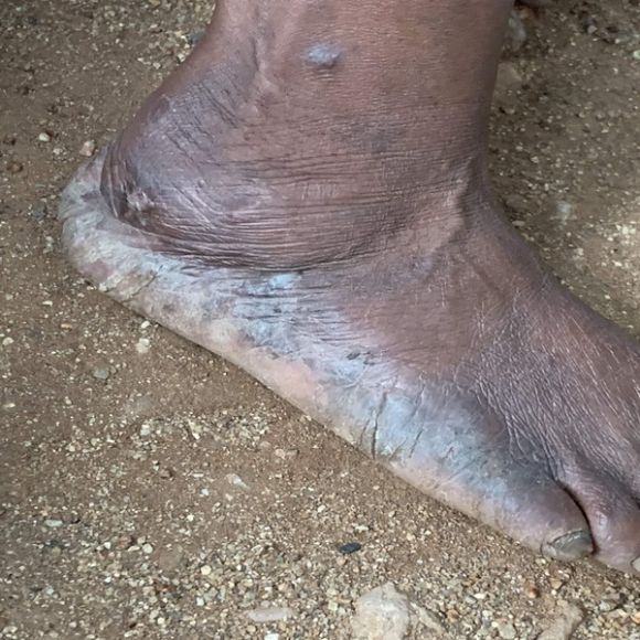The feet and ankle of a lower caste worker in Mabbuchintalapalle. There are several wounds The ankle side of his feet, throughout, has several wounds and the ankle seems swollen. There are also a few wound and black pigmentations above his ankle. 