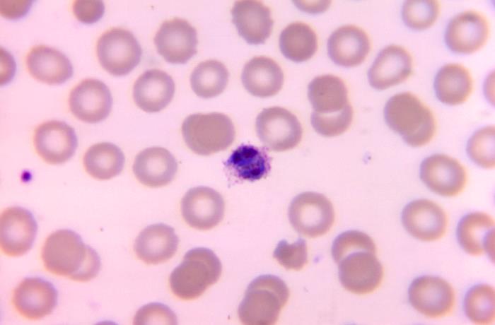Image is a micrograph, captured through a microscope. The background is pink and it shows a blood smear revealing Plasmodium ovale, one of several species responsible for malaria in humans.